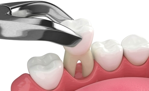 Fundamentals Of Complex Extractions And Socket Grafting