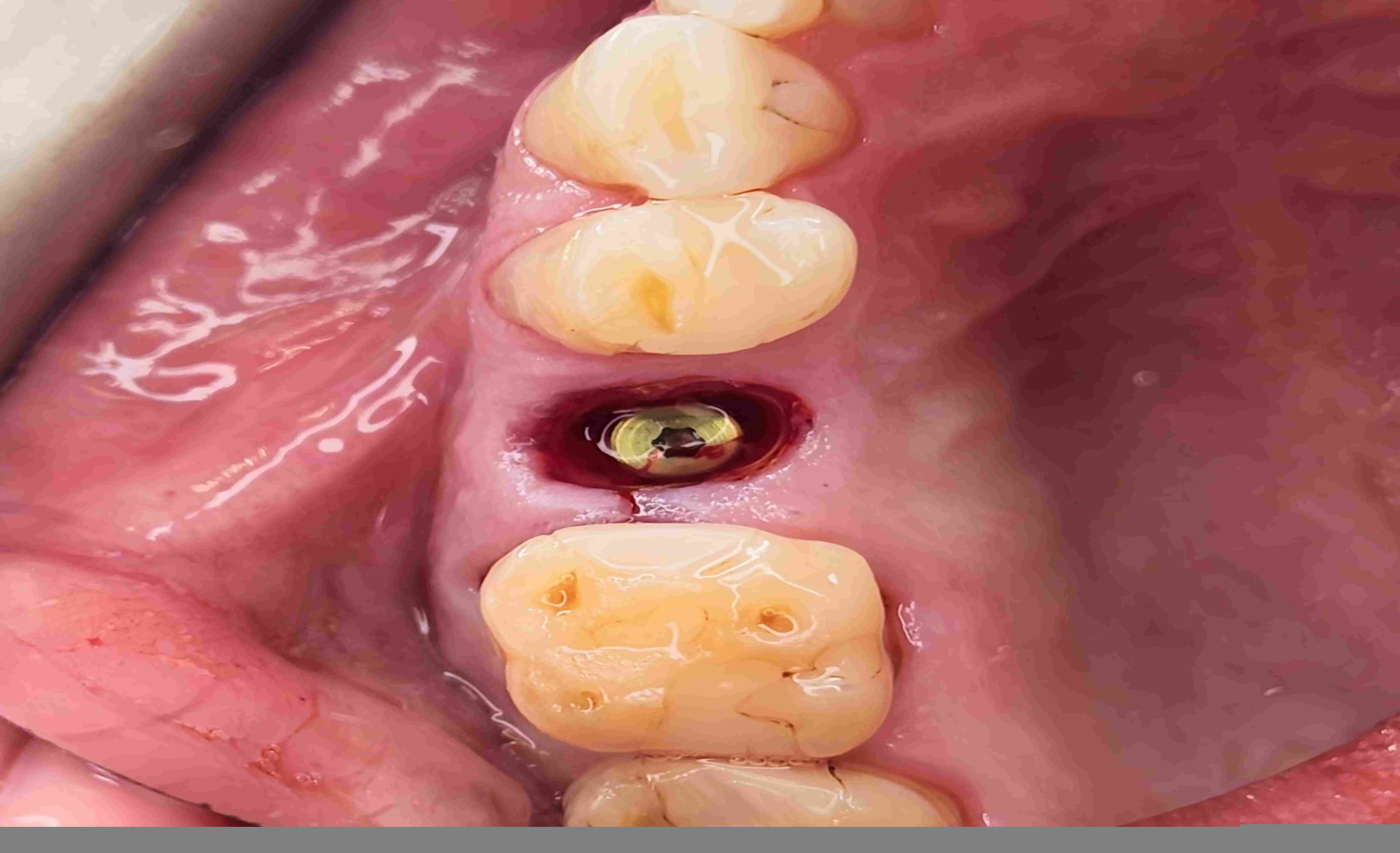Immediate Implants - Calgary