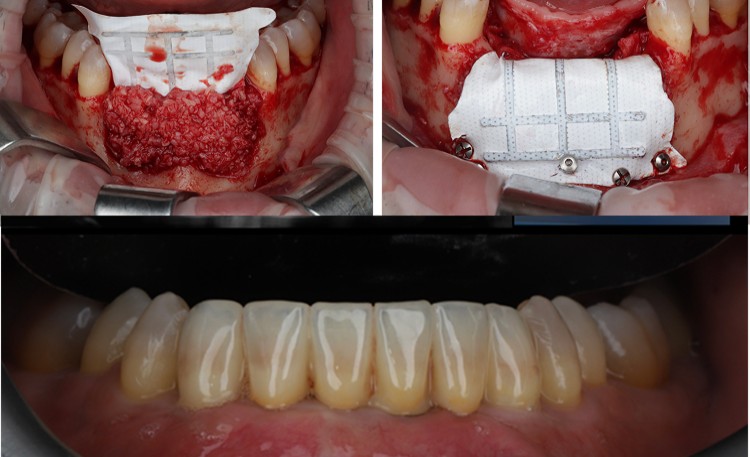 Masterclass In Bone Augmentation