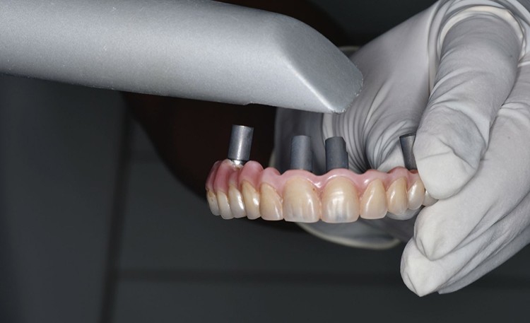 Partial Extraction Therapy + Full Arch Teeth Xpress Protocol