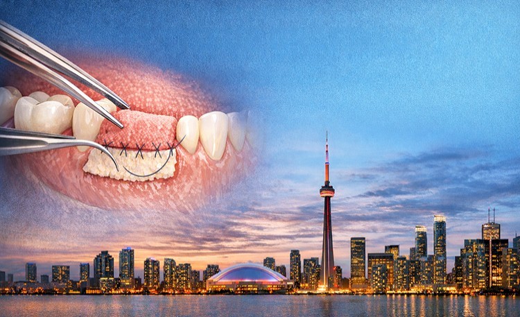 Introduction To Soft Tissue Grafting - Toronto, Ontario