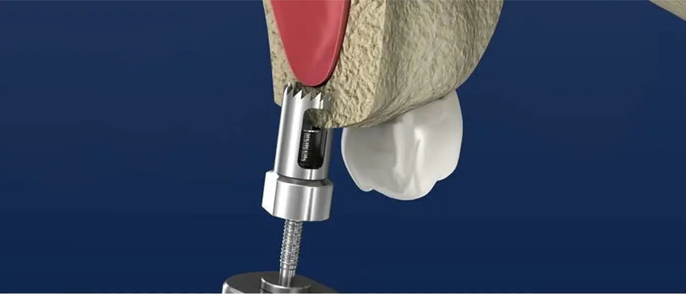Direct Sinus Surgery 
