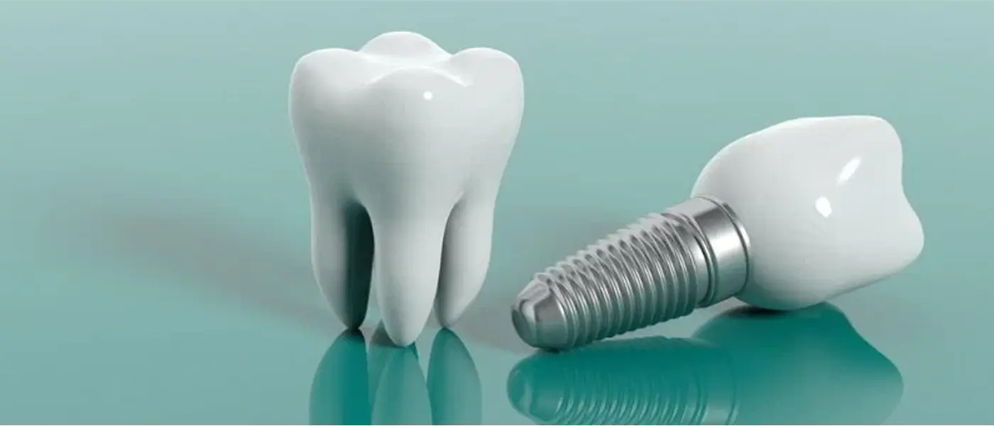 Immediate Implants – Part – 2