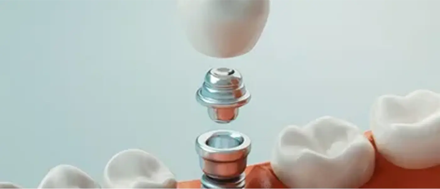 Immediate Implants – Part – 1